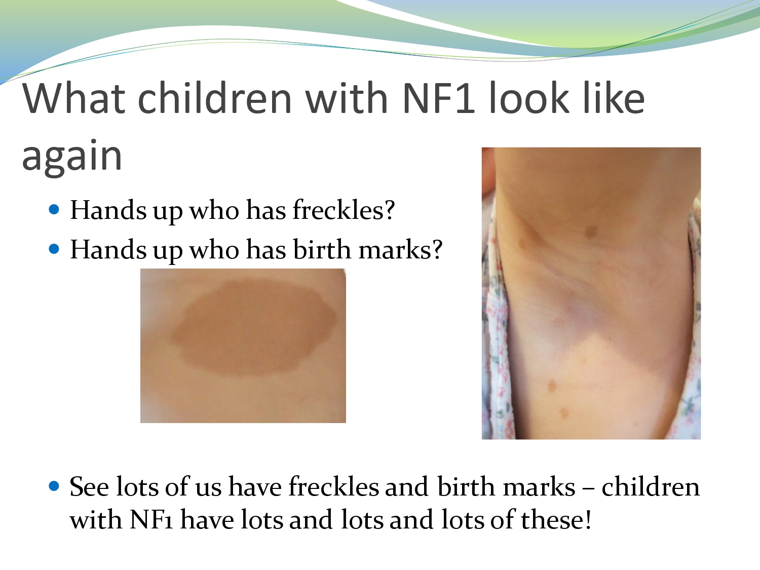 What Is Neurofibromatosis Type 1 Nf1 Rare Diseases Foundation Of Iran 3419