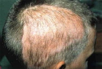 آلوپسی آره آتا (Alopecia Areata)