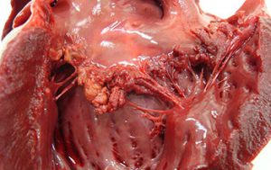 Endocarditis of the mitral valve
