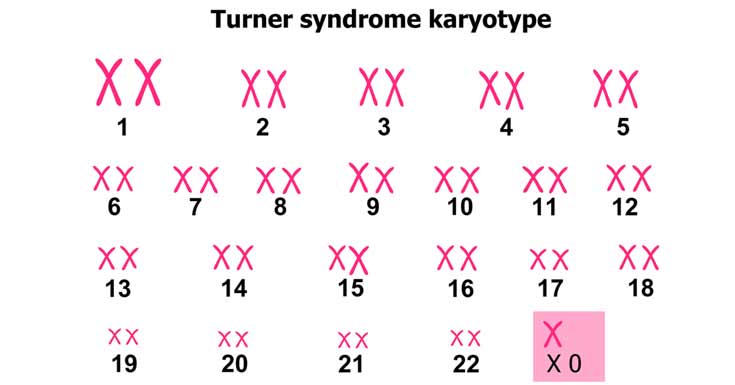 turner-syndrome